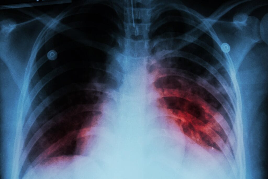Ufahamu Ugonjwa wa Kifua Kikuu – Tuberculosis (TB)